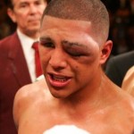 My New Fetish: Boxing Welts *nhjic*